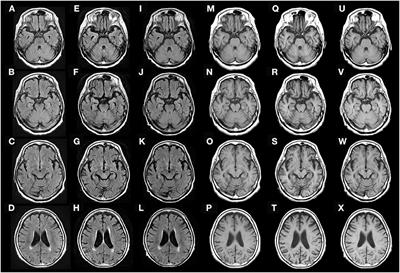 Case report: Reversible brain atrophy with low titer anti-amphiphysin antibodies related to gastric adenocarcinoma